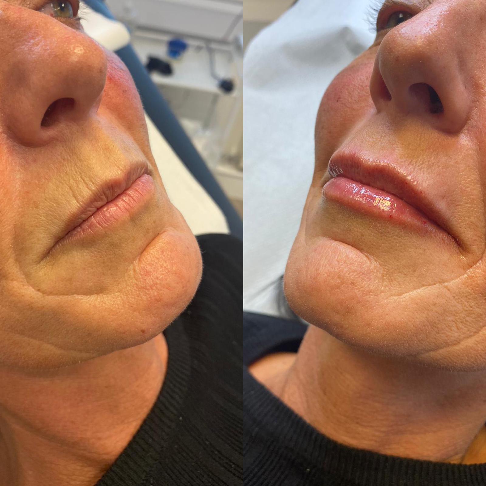 Lip Fillers deeside